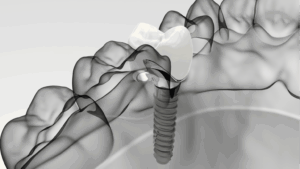 Dental Implants Congleton Cheshire Consultations Now Available for Private Patients at Crown Bank Dental